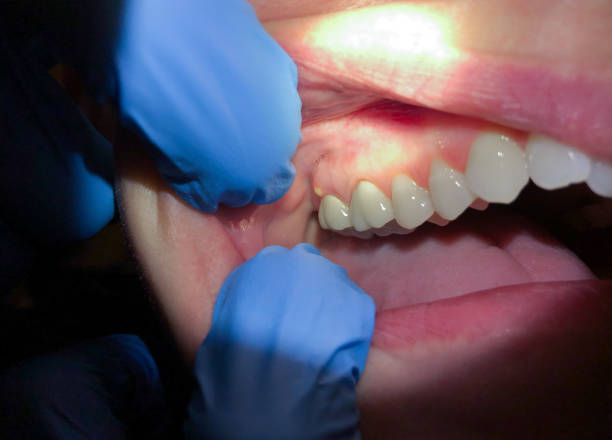 Best Emergency Root Canal Treatment in Rye Brook, NY