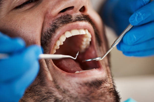 Best Emergency Wisdom Teeth Removal in Rye Brook, NY