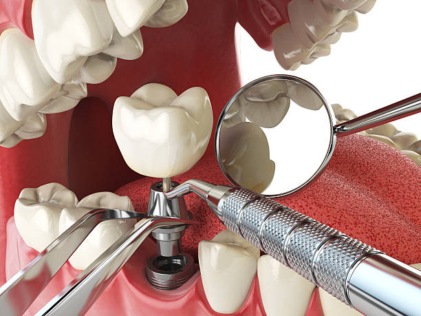 Best Emergency Tooth Extraction in Rye Brook, NY